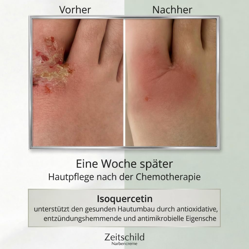 Narbencreme 30 ml, für frische & ältere Narben, auch nach OP, Kaiserschnitt & Aknenarben, mit Madecassoside, 4-fach Hyaluron & Ectoin, Made in Germany