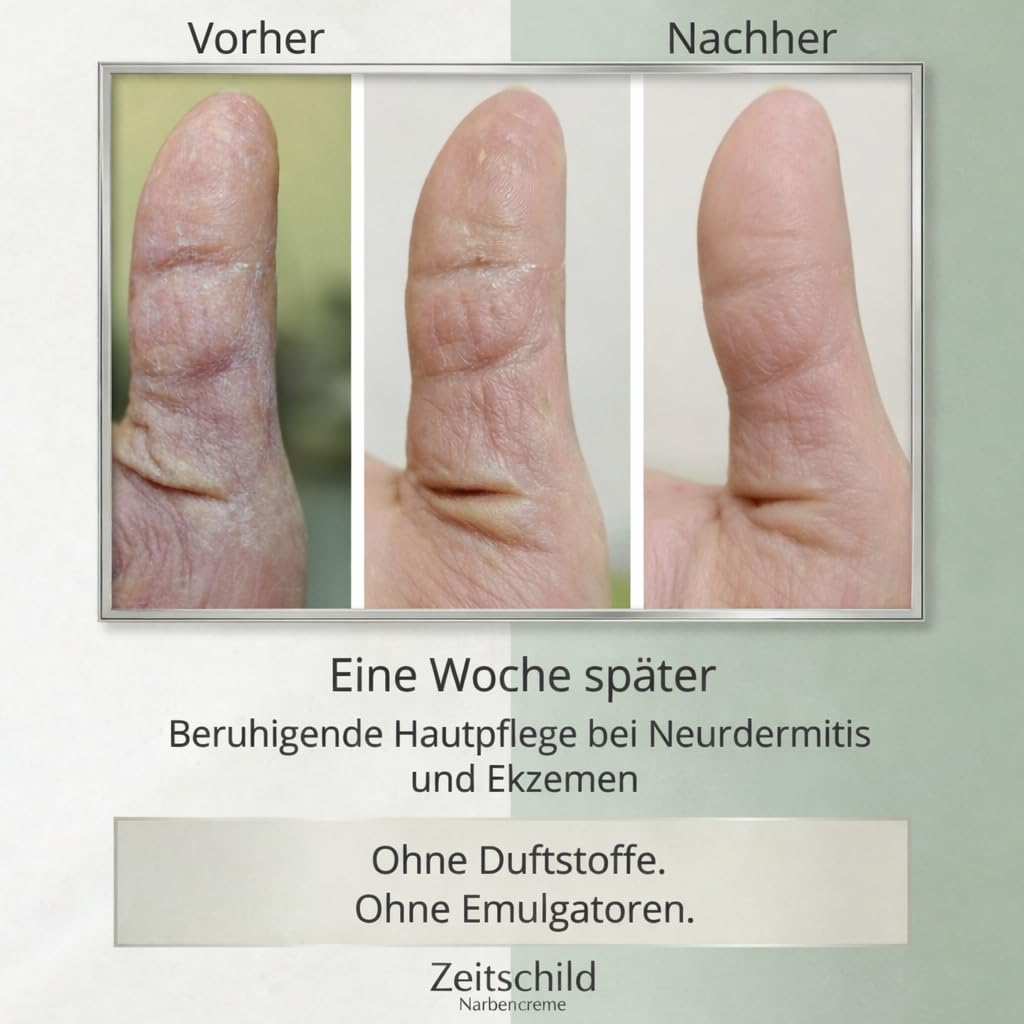 Narbencreme 30 ml, für frische & ältere Narben, auch nach OP, Kaiserschnitt & Aknenarben, mit Madecassoside, 4-fach Hyaluron & Ectoin, Made in Germany