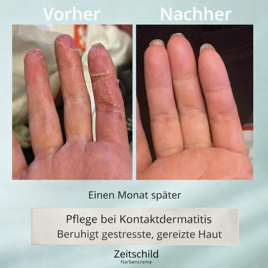 Narbencreme 30 ml, für frische & ältere Narben, auch nach OP, Kaiserschnitt & Aknenarben, mit Madecassoside, 4-fach Hyaluron & Ectoin, Made in Germany