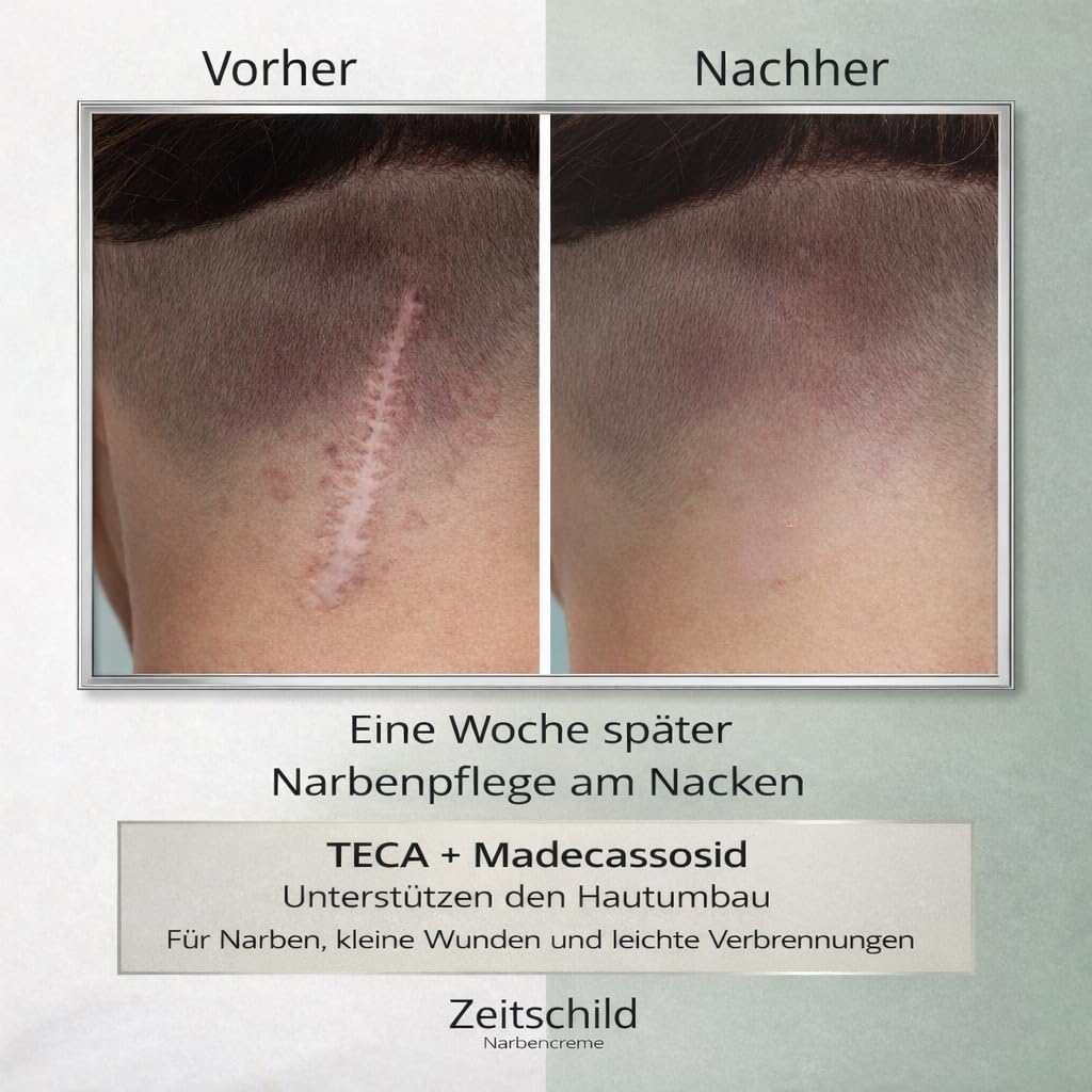 Narbencreme 30 ml, für frische & ältere Narben, auch nach OP, Kaiserschnitt & Aknenarben, mit Madecassoside, 4-fach Hyaluron & Ectoin, Made in Germany