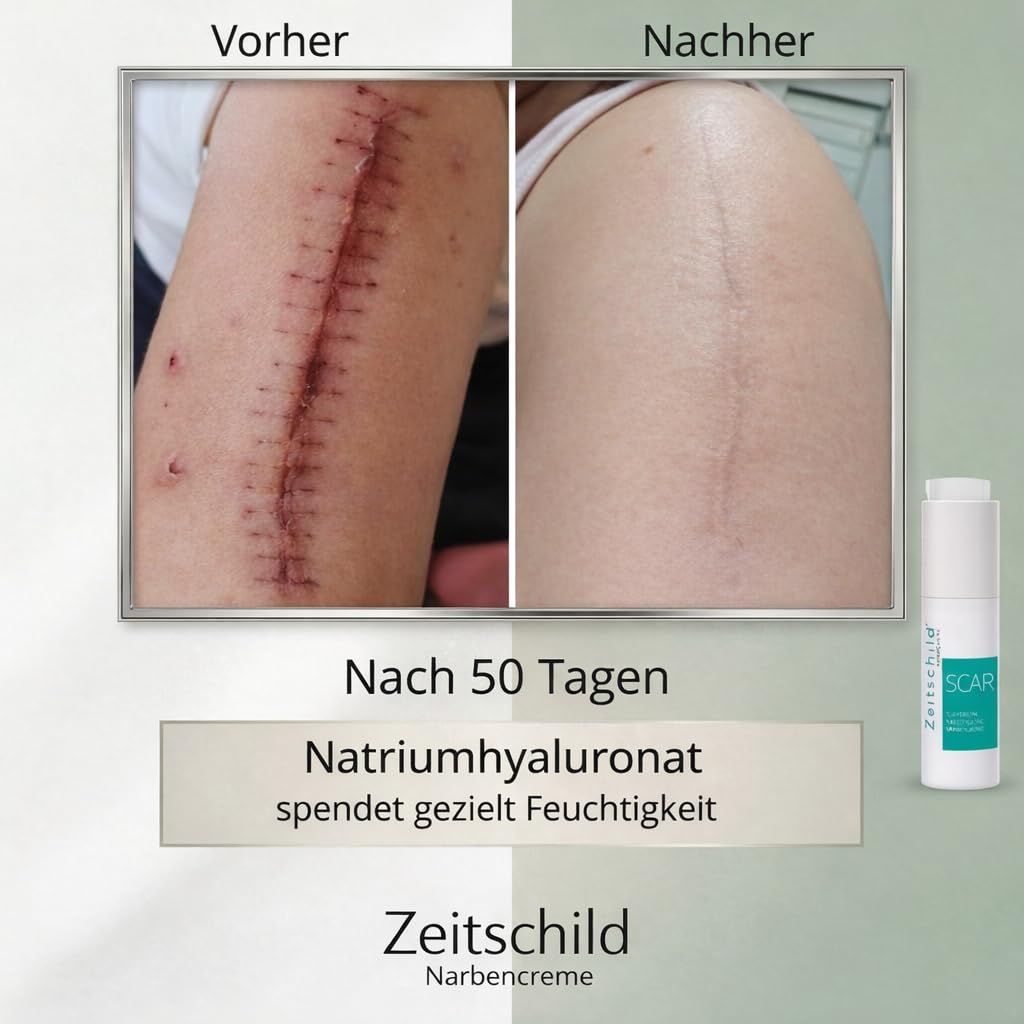 Narbencreme 30 ml, für frische & ältere Narben, auch nach OP, Kaiserschnitt & Aknenarben, mit Madecassoside, 4-fach Hyaluron & Ectoin, Made in Germany