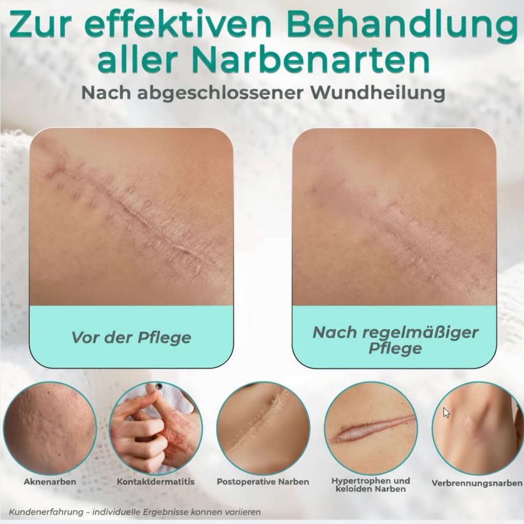 Narbencreme 30 ml, für frische & ältere Narben, auch nach OP, Kaiserschnitt & Aknenarben, mit Madecassoside, 4-fach Hyaluron & Ectoin, Made in Germany
