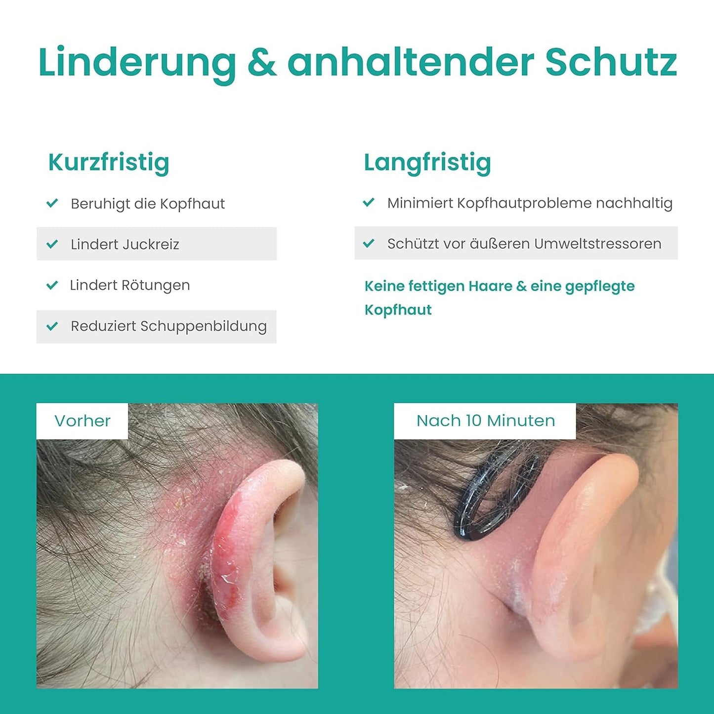 Kopfhaut Pflege - Intensiv – Bei Juckreiz, Trockenheit & Schuppen – mit Niacinamid (Vitamin B3) – parfumfrei, leichte Lotion, Scalp Repair & Relief Lotion 90 ml