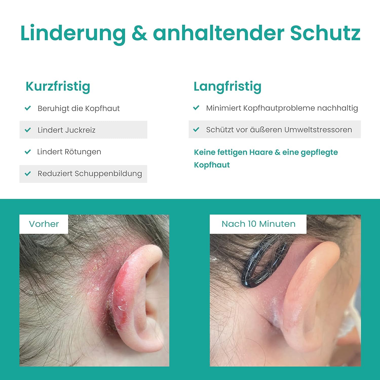 Kopfhaut Pflege - Intensiv – Bei Juckreiz, Trockenheit & Schuppen – mit Niacinamid (Vitamin B3) – parfumfrei, leichte Lotion, Scalp Repair & Relief Lotion 90 ml